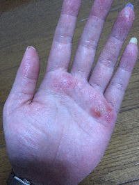手湿疹